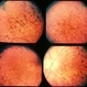 Retinitis Pigmentosa